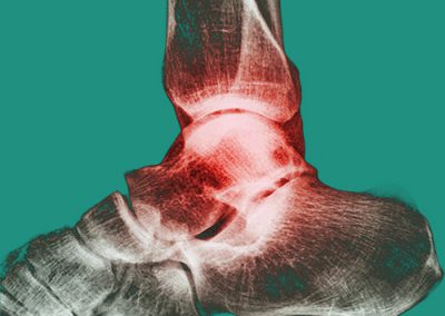 Douleurs dans les Chevilles Mésothérapie