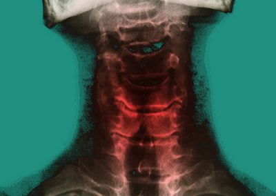 Douleur raideur de la colonne cervicale