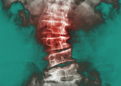 Raideur Colonne Lombaire Mésothérapie