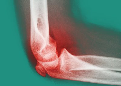 Épicondylite Épitrochléite Douleur Coude