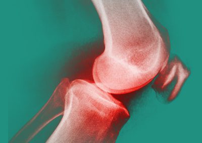 Les Pathologies des Genoux