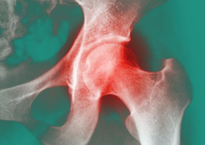 Douleur dans les Hanches Mésothérapie