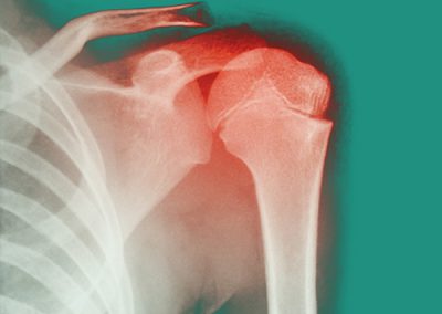 Limitation douleurs dans les Épaules