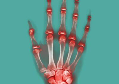 Arthrose Rhumatisme Douleur Main